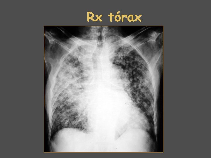 Rx tórax 