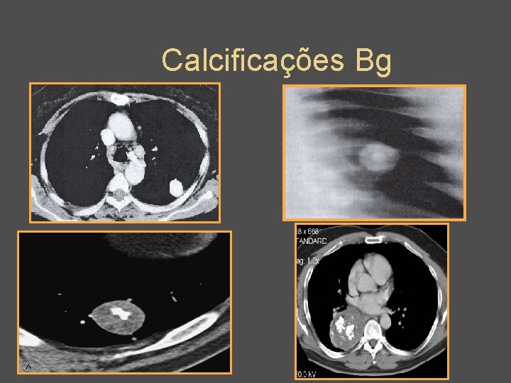 Calcificações Bg 