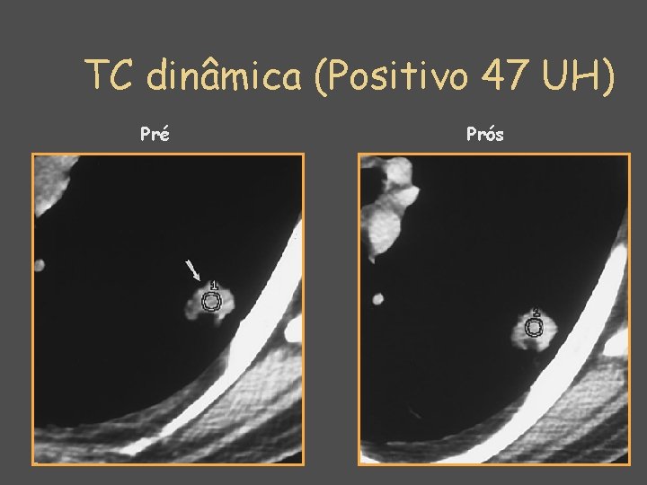 TC dinâmica (Positivo 47 UH) Pré Prós 