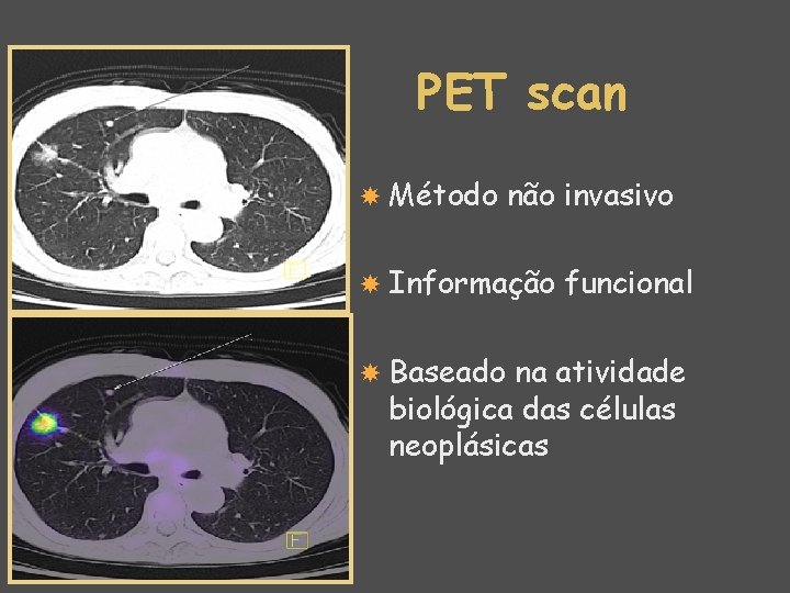 PET scan Método não invasivo Informação Baseado funcional na atividade biológica das células neoplásicas