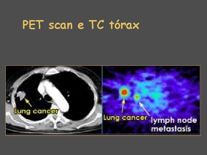 PET scan e TC tórax 