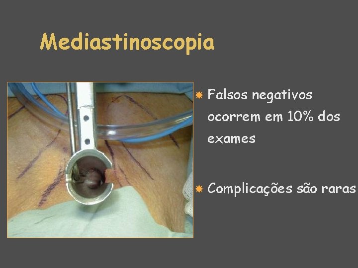 Mediastinoscopia Falsos negativos ocorrem em 10% dos exames Complicações são raras 