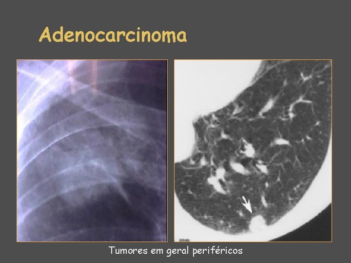 Adenocarcinoma Tumores em geral periféricos 