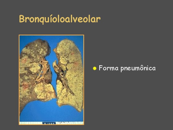 Bronquíoloalveolar ® Forma pneumônica 