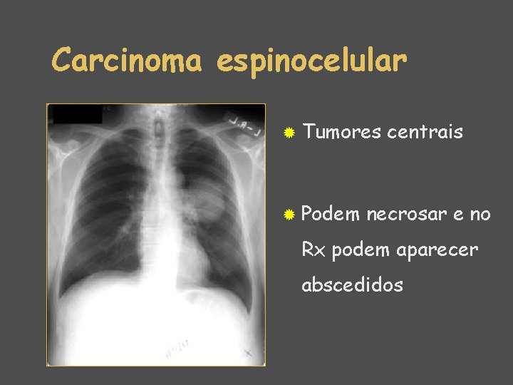 Carcinoma espinocelular ® Tumores ® Podem centrais necrosar e no Rx podem aparecer abscedidos