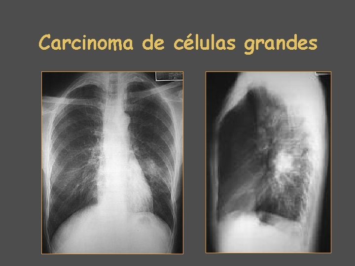 Carcinoma de células grandes 