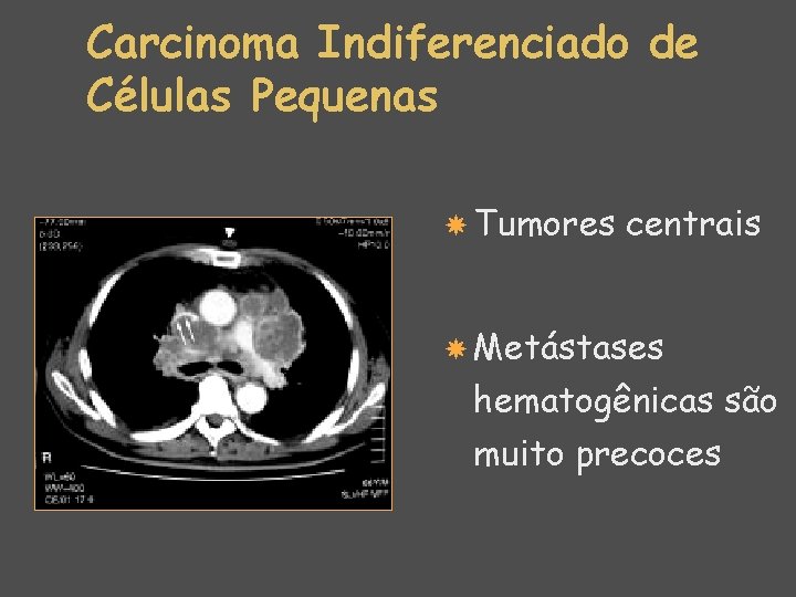 Carcinoma Indiferenciado de Células Pequenas Tumores centrais Metástases hematogênicas são muito precoces 