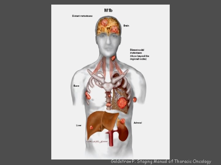 Goldstraw P. Staging Manual of Thoracic Oncology 