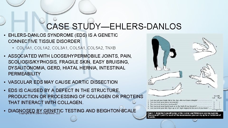 CASE STUDY—EHLERS-DANLOS • EHLERS-DANLOS SYNDROME (EDS) IS A GENETIC CONNECTIVE TISSUE DISORDER • COL