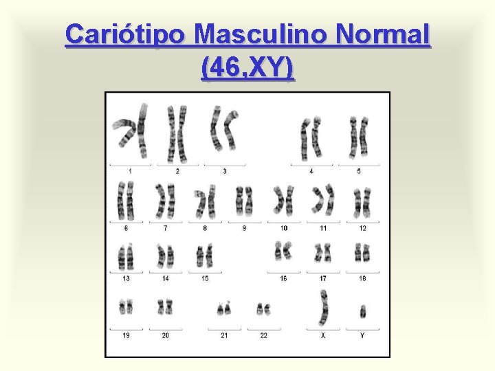 Cariótipo Masculino Normal (46, XY) 