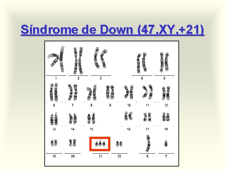 Síndrome de Down (47, XY, +21) 