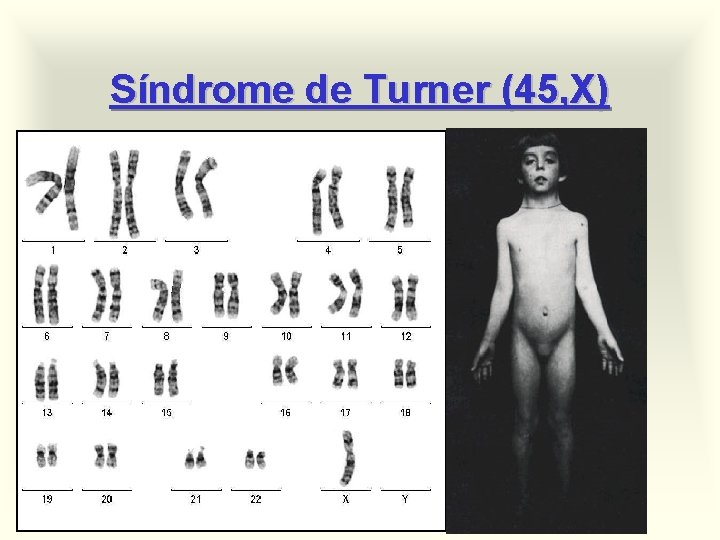 Síndrome de Turner (45, X) 