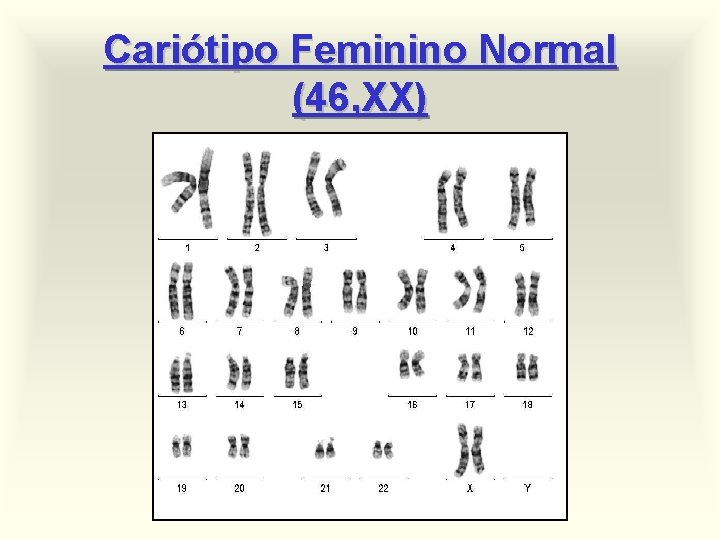 Cariótipo Feminino Normal (46, XX) 