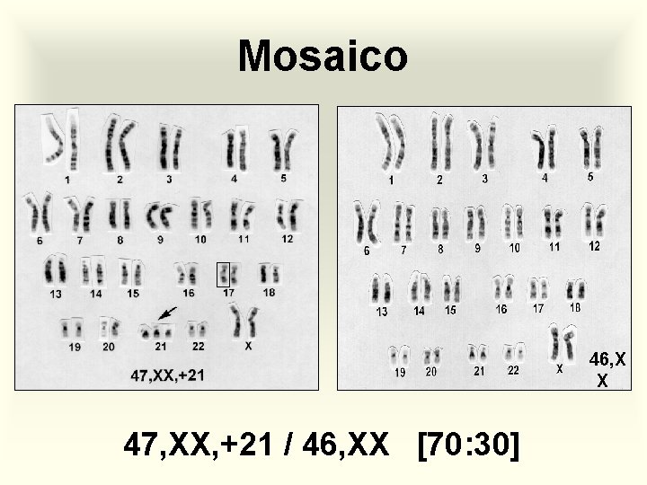 Mosaico 46, X X 47, XX, +21 / 46, XX [70: 30] 