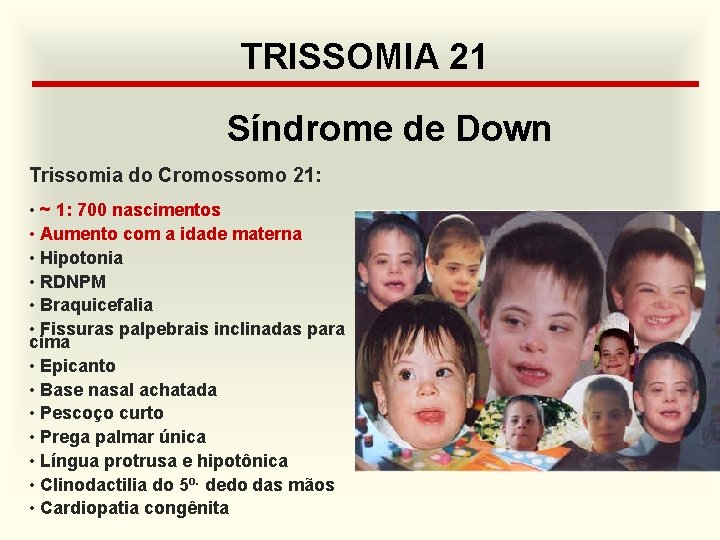 TRISSOMIA 21 Síndrome de Down Trissomia do Cromossomo 21: • ~ 1: 700 nascimentos