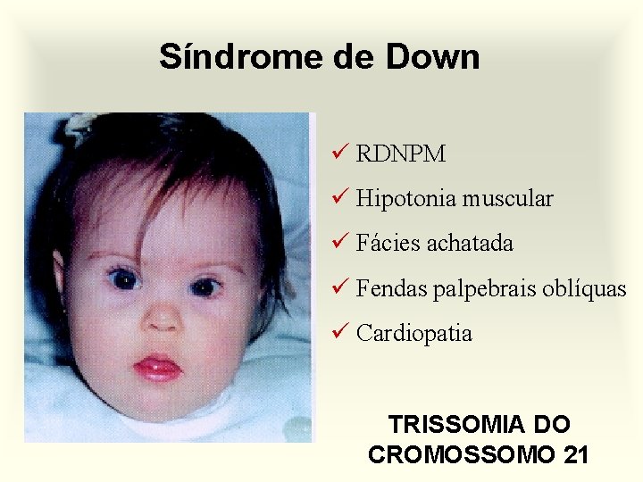 Síndrome de Down ü RDNPM ü Hipotonia muscular ü Fácies achatada ü Fendas palpebrais
