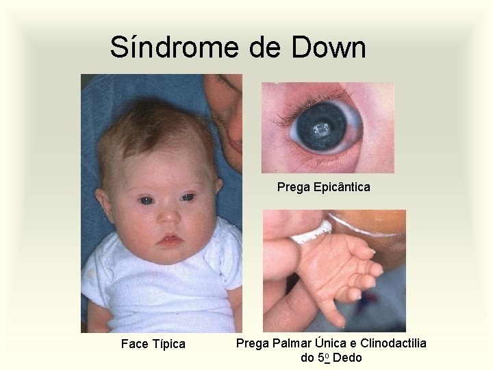 Síndrome de Down Prega Epicântica Face Típica Prega Palmar Única e Clinodactilia do 5