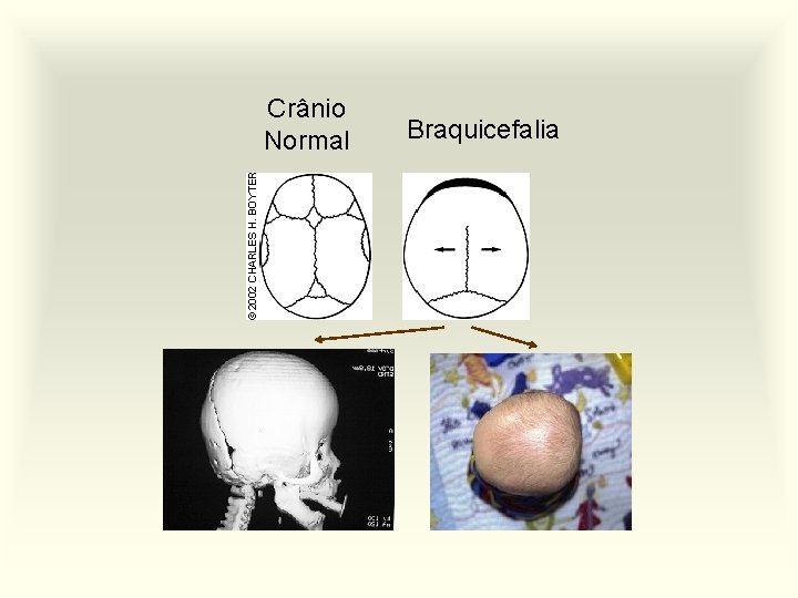 Crânio Normal Braquicefalia 