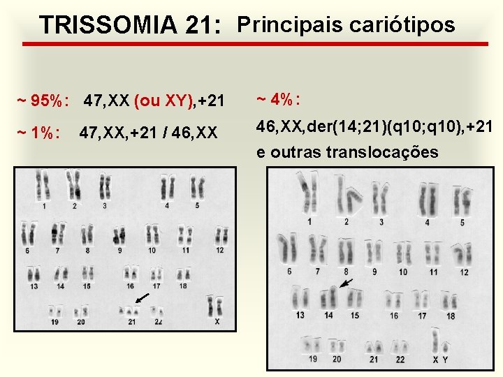 TRISSOMIA 21: Principais cariótipos ~ 95%: 47, XX (ou XY), +21 ~ 4%: ~