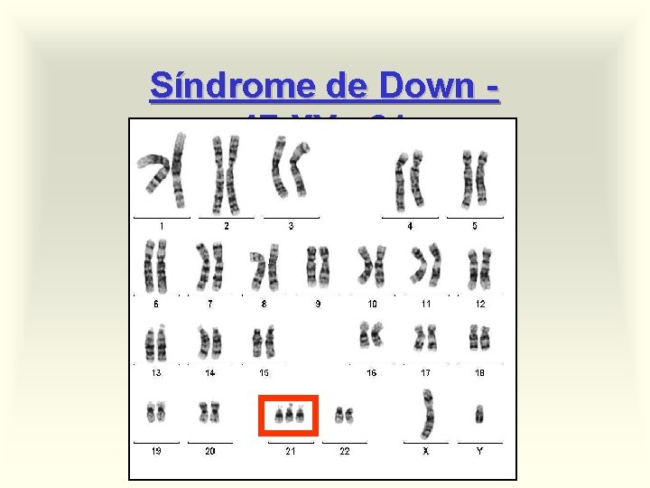 Síndrome de Down 47, XY, +21 
