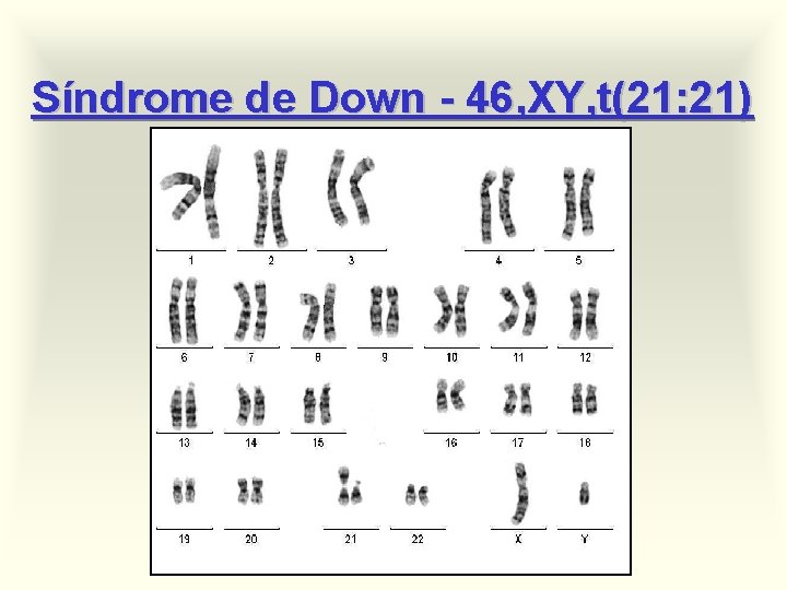 Síndrome de Down - 46, XY, t(21: 21) 