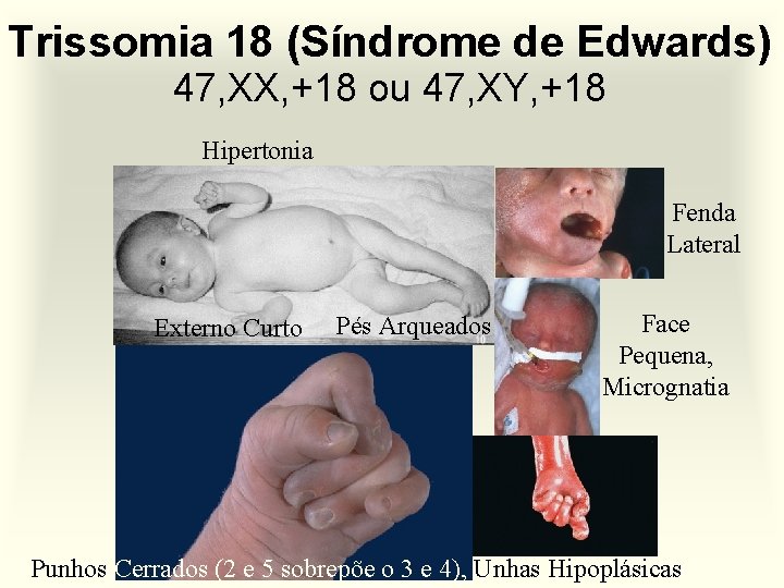 Trissomia 18 (Síndrome de Edwards) 47, XX, +18 ou 47, XY, +18 Hipertonia Fenda