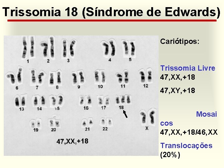 Trissomia 18 (Síndrome de Edwards) Cariótipos: Trissomia Livre 47, XX, +18 47, XY, +18