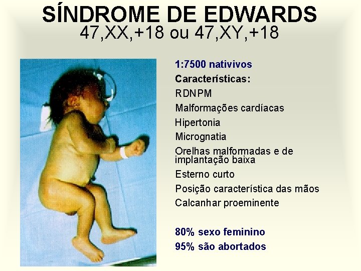 SÍNDROME DE EDWARDS 47, XX, +18 ou 47, XY, +18 1: 7500 nativivos Características: