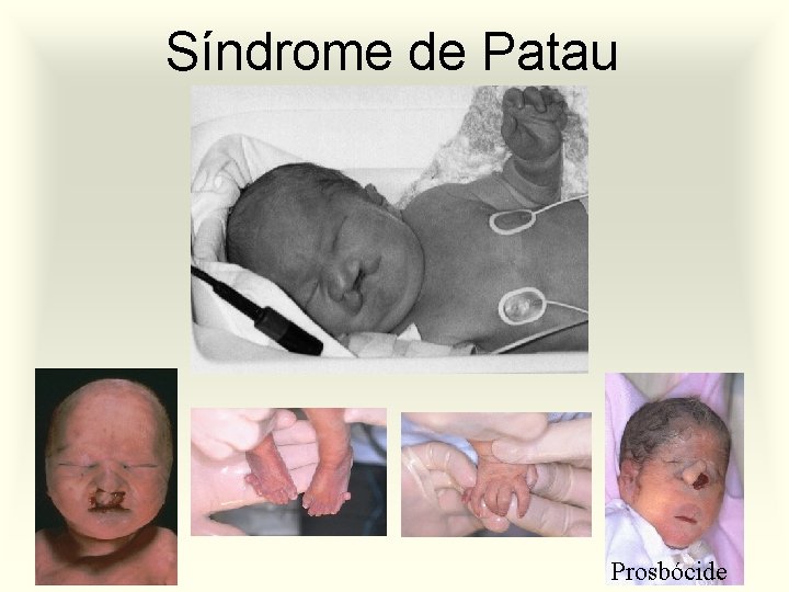 Síndrome de Patau Prosbócide 
