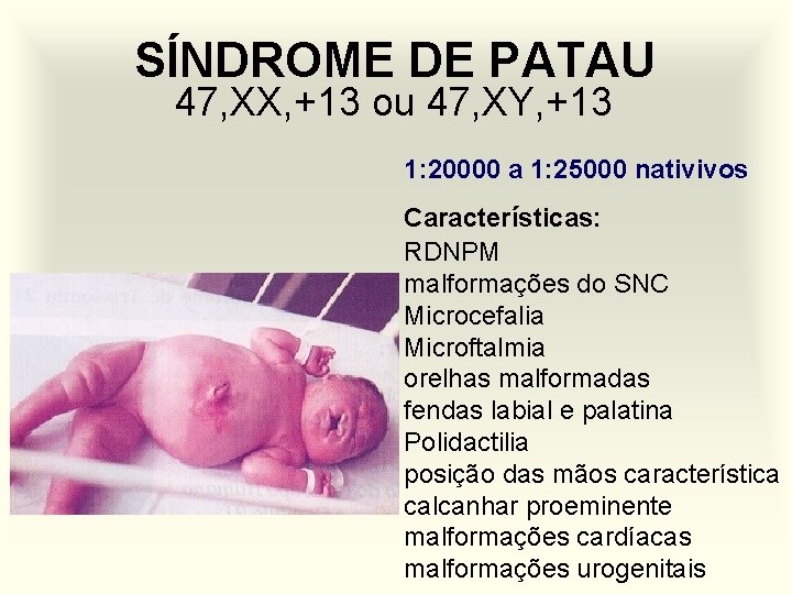 SÍNDROME DE PATAU 47, XX, +13 ou 47, XY, +13 1: 20000 a 1: