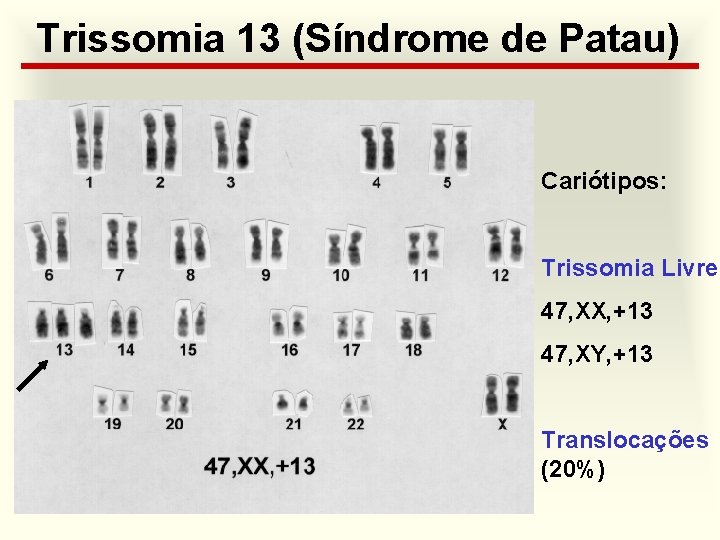 Trissomia 13 (Síndrome de Patau) Cariótipos: Trissomia Livre 47, XX, +13 47, XY, +13