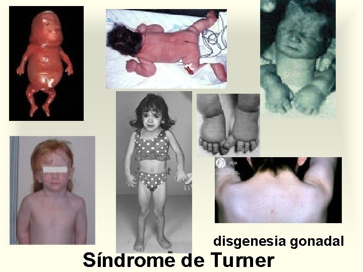 disgenesia gonadal Síndrome de Turner 