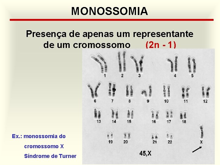 MONOSSOMIA Presença de apenas um representante de um cromossomo (2 n - 1) Ex.