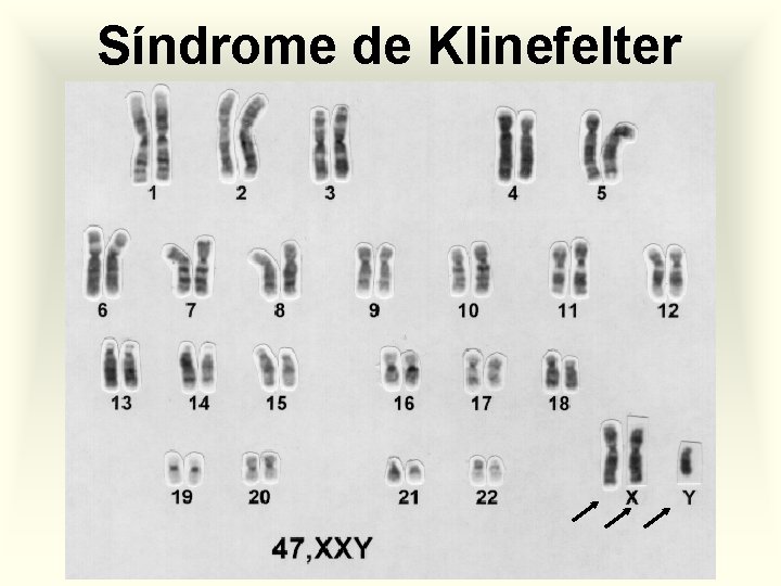 Síndrome de Klinefelter 