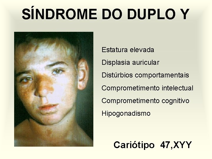 SÍNDROME DO DUPLO Y Estatura elevada Displasia auricular Distúrbios comportamentais Comprometimento intelectual Comprometimento cognitivo