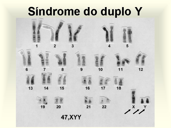 Síndrome do duplo Y 