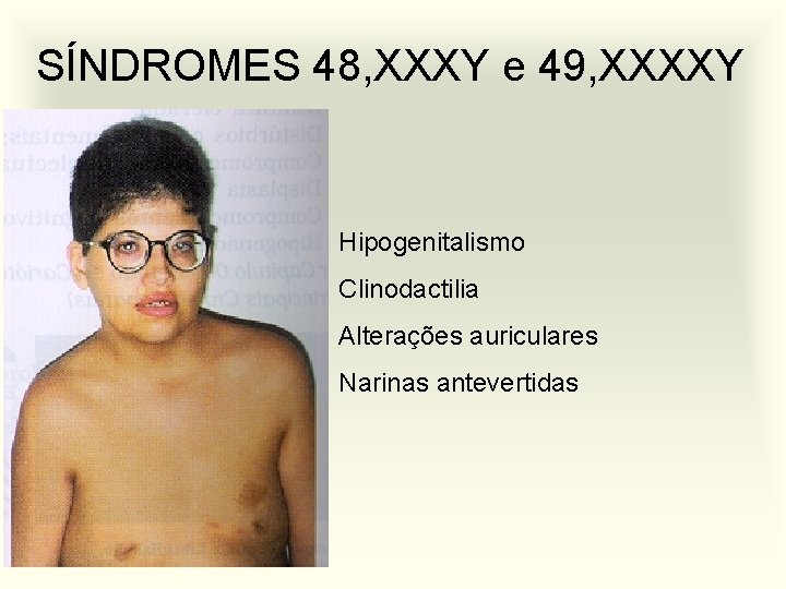 SÍNDROMES 48, XXXY e 49, XXXXY Hipogenitalismo Clinodactilia Alterações auriculares Narinas antevertidas 
