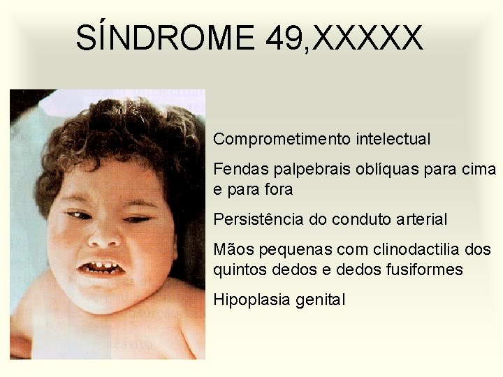 SÍNDROME 49, XXXXX Comprometimento intelectual Fendas palpebrais oblíquas para cima e para fora Persistência