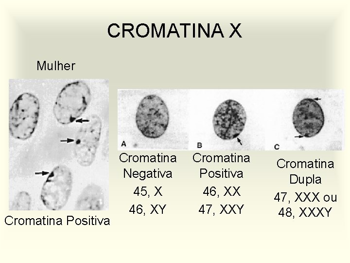 CROMATINA X Mulher Cromatina Positiva Cromatina Negativa 45, X 46, XY Cromatina Positiva 46,