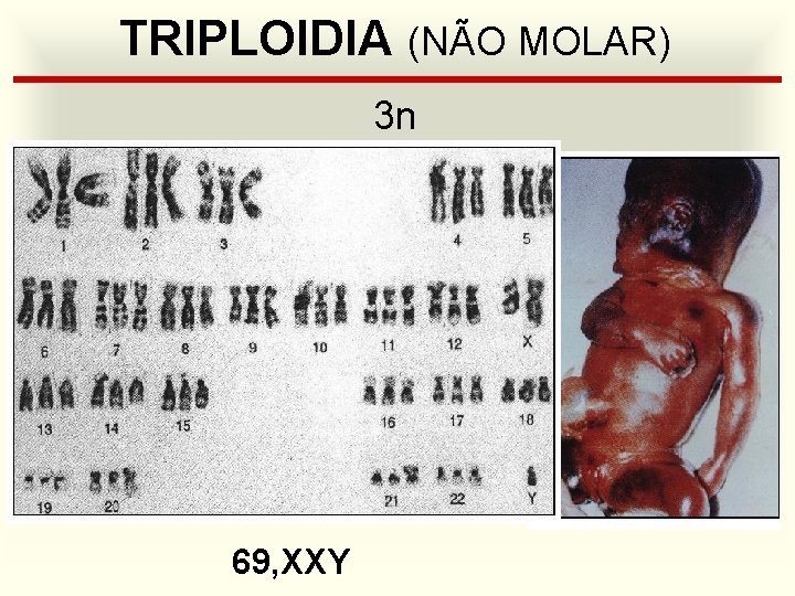 TRIPLOIDIA (NÃO MOLAR) 3 n 69, XXY 