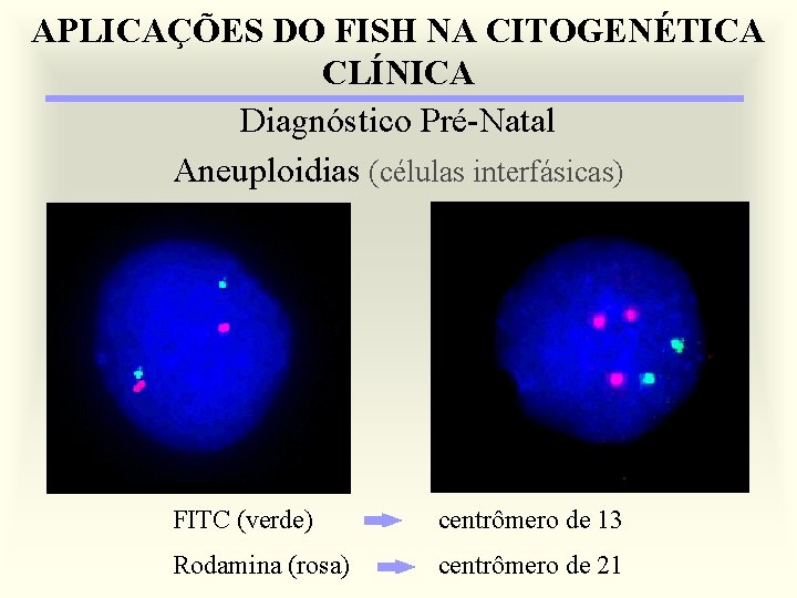 APLICAÇÕES DO FISH NA CITOGENÉTICA CLÍNICA Diagnóstico Pré-Natal Aneuploidias (células interfásicas) FITC (verde) centrômero