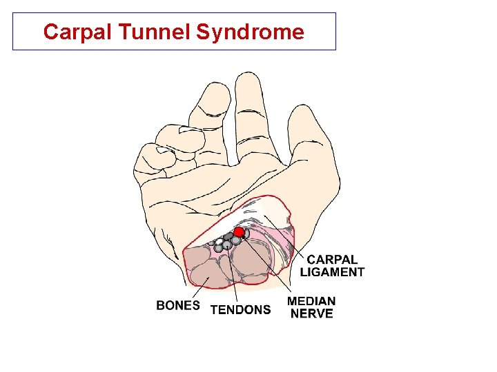 Carpal Tunnel Syndrome 