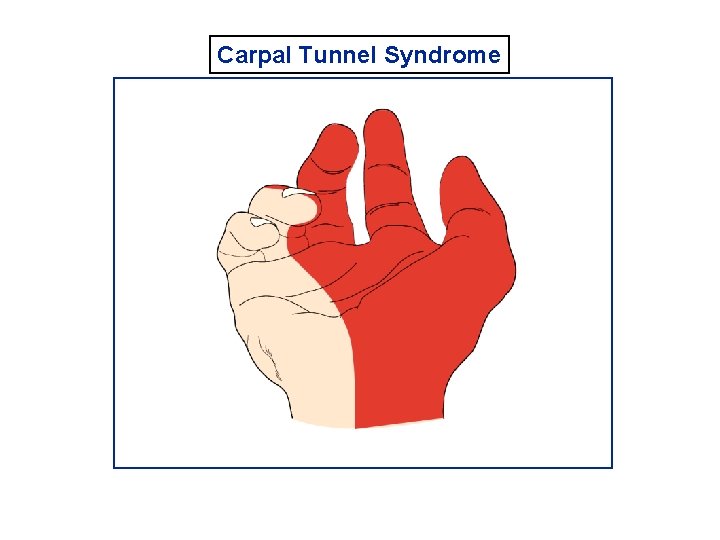 Carpal Tunnel Syndrome 