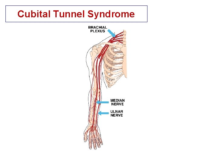 Cubital Tunnel Syndrome 