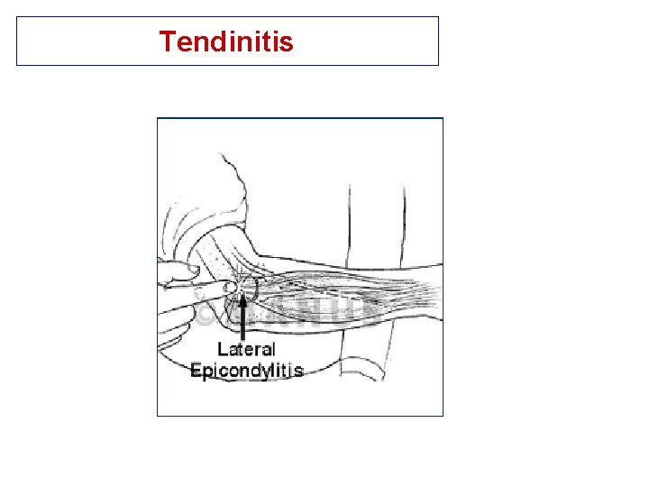 Tendinitis 