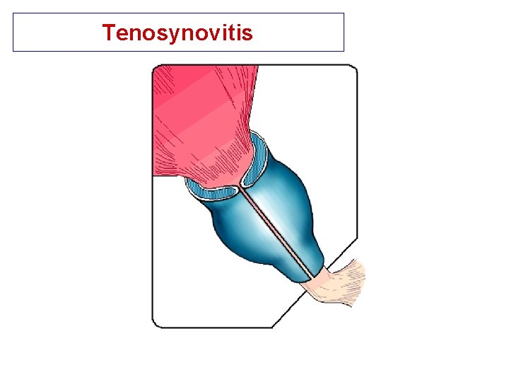 Tenosynovitis 