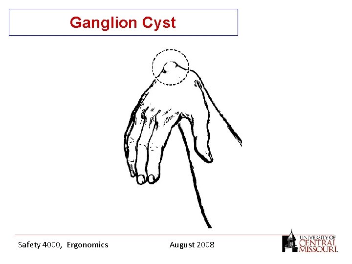 Ganglion Cyst Safety 4000, Ergonomics August 2008 