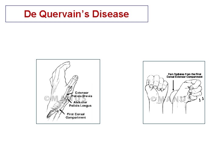 De Quervain’s Disease 