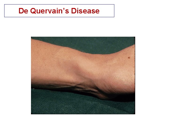 De Quervain’s Disease 