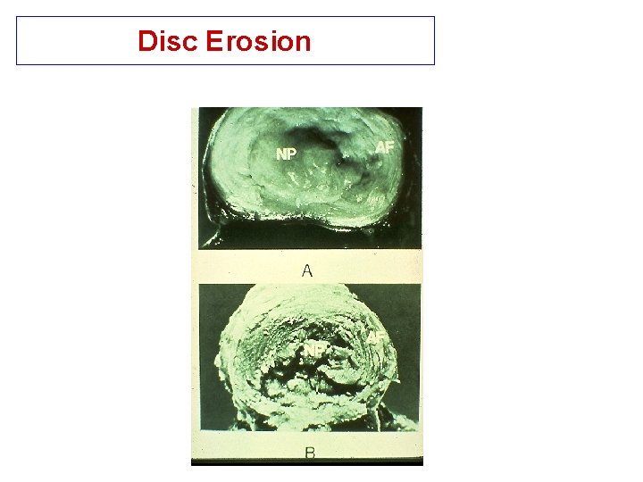 Disc Erosion 